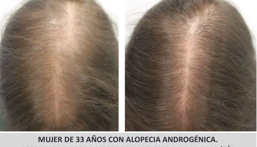 Comparativa de cabello de mujer de 33 años con alopecia androgenética, mostrando mejora tras 12 meses de tratamiento con minoxidil oral.