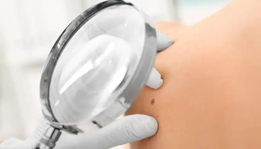 Examen d'un grain de beauté sur un mamelon, possible apparition durant la grossesse.