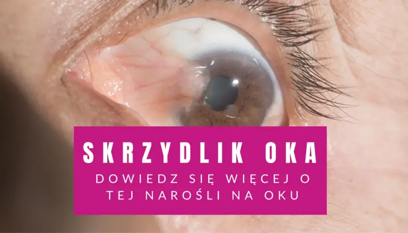 Zbliżenie na oko z widocznym skrzydlikiem. Różowy pasek z tekstem "SKRZYDLIK OKA".