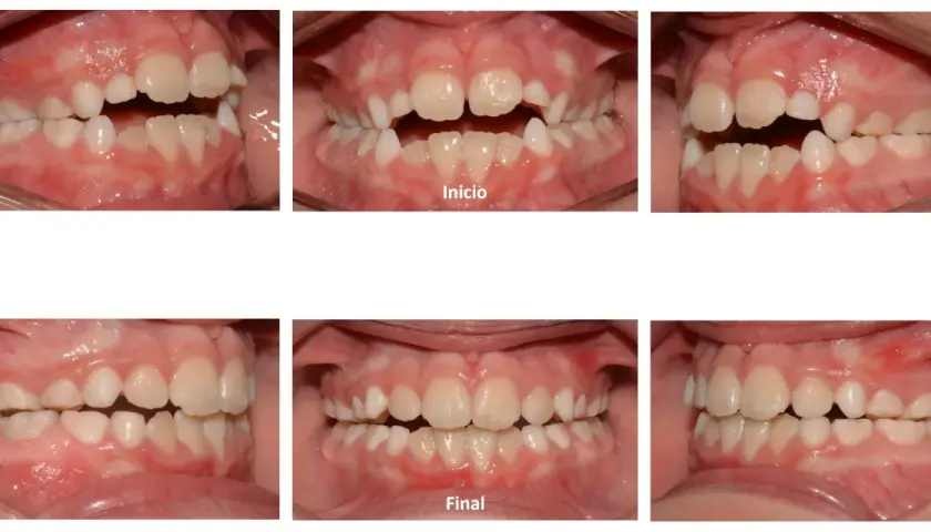 Niño con mordida abierta antes y después. Las imágenes muestran la corrección de la alineación dental, logrando una oclusión perfecta.