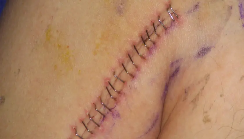 Gros plan sur une cicatrice suturée avec des agrafes chirurgicales. Un point de suture qui saute est visible, indiquant une possible complication.