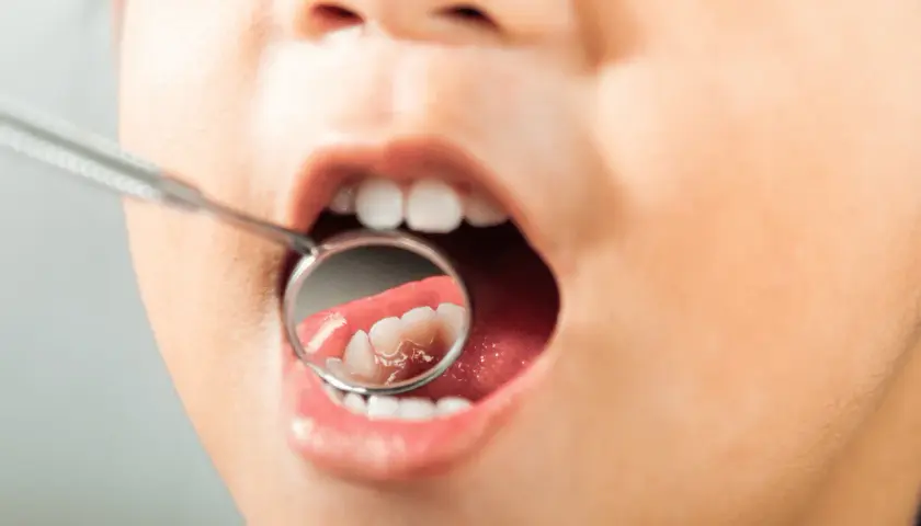 Bambino con bocca aperta e specchietto dentale. Si intravedono i denti, ma l'immagine suggerisce la preoccupazione per i denti marci nei bambini.