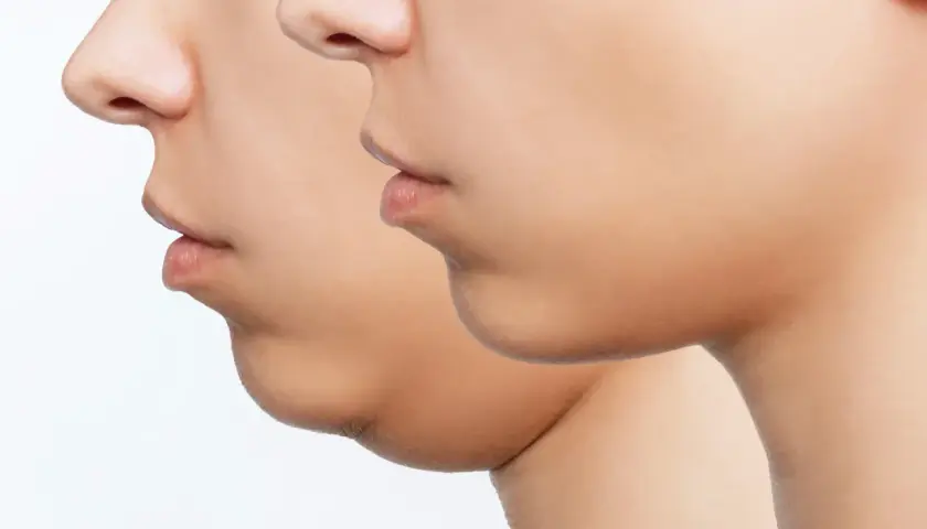 Perfil de un rostro mostrando la reducción de la papada.