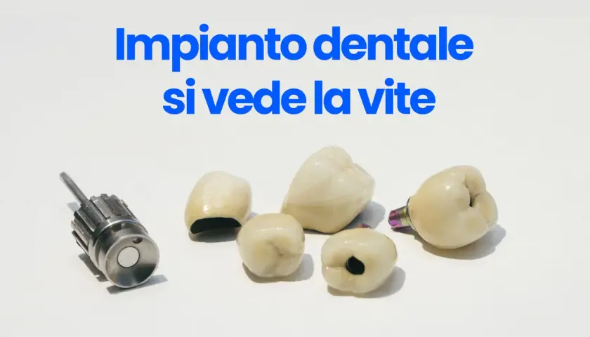 Componenti di un impianto dentale, inclusa una vite, su sfondo bianco.