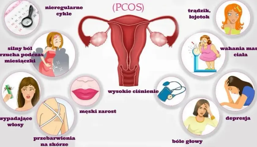 PCO syndrom co to jest - objawy, diagnoza i skutki zdrowotne