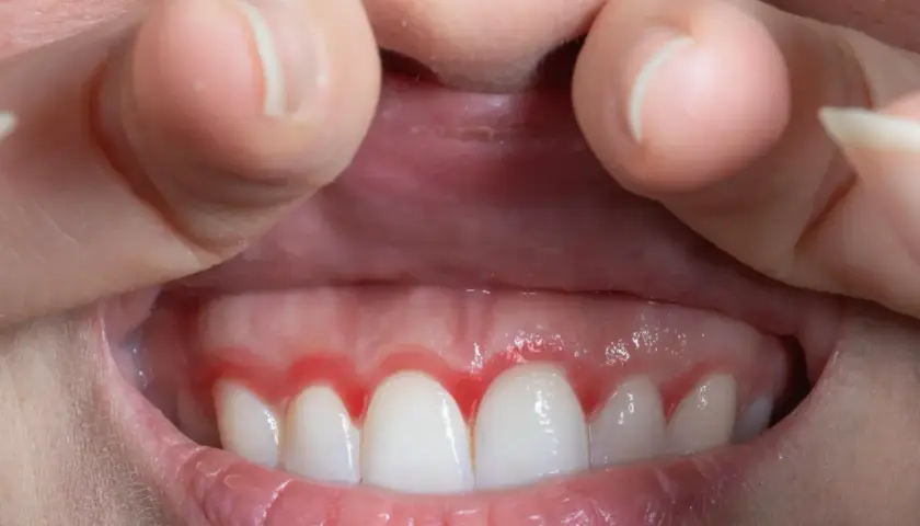 Dientes blancos con encía roja e inflamada alrededor.
