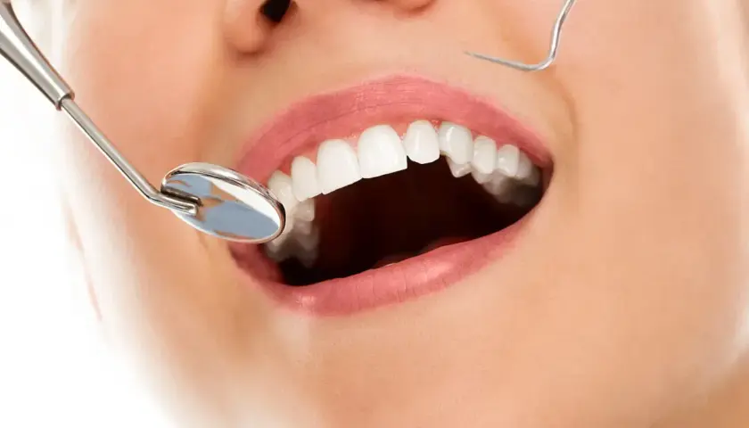 Uśmiechnięte usta z białymi zębami, lustro dentystyczne i sonda. Zabieg kiretaż może pomóc w osiągnięciu takiego efektu.