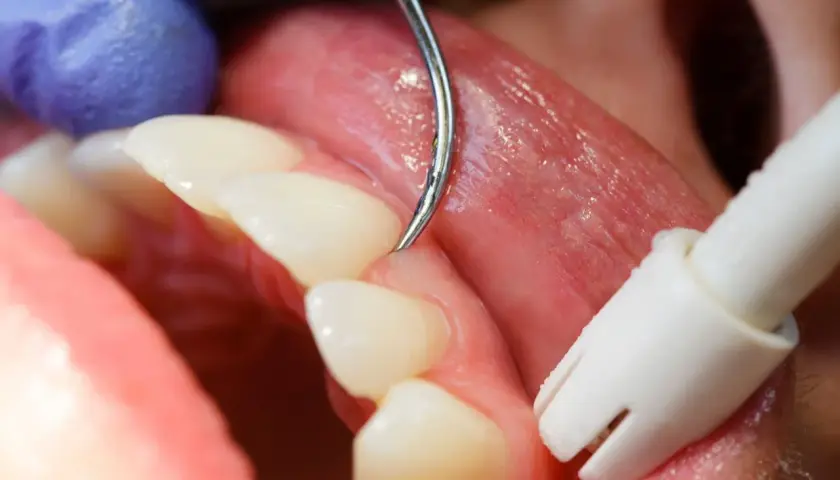 Detalles de un tratamiento dental para como tratar la gingivitis. Se observa un instrumento dental limpiando la línea de las encías.