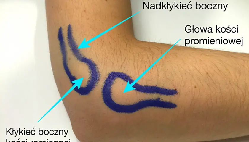 Zaznaczone obszary na łokciu do testu na łokieć tenisisty: nadkłykieć boczny, głowa kości promieniowej, kłykieć boczny kości ramiennej.