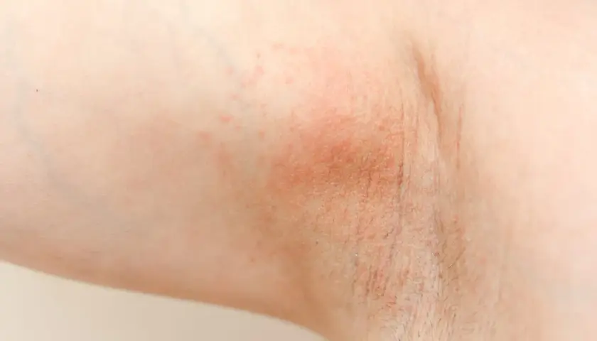 Czerwona, swędząca skóra pod pachą, objaw uczulenia na antyperspirant.