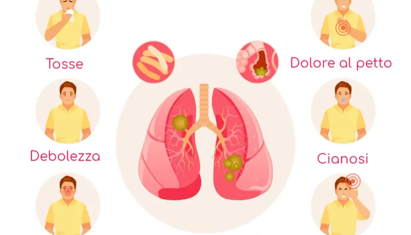 Polmonite: tosse, debolezza, febbre, dolore al petto, cianosi, mal di testa. L'immagine illustra i sintomi della polmonite, inclusa la polmonite ab ingestis.