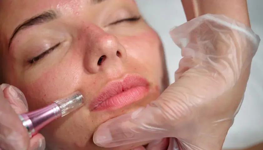 Zabieg dermapenem na twarz. Widoczne zaczerwienienie i drobne nakłucia, zapowiedź przyszłych dermapen efekty.