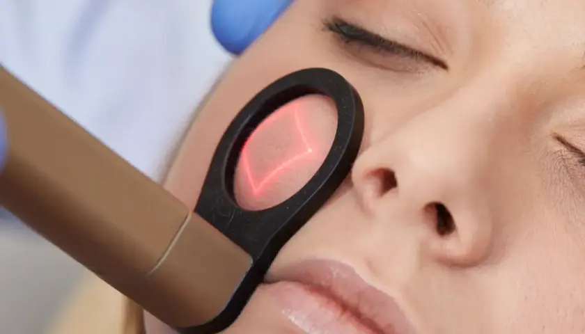 Närbild på ett ansikte som får laserbehandling. En hand med blå handske håller en apparat som riktar en röd laserstråle mot kinden.