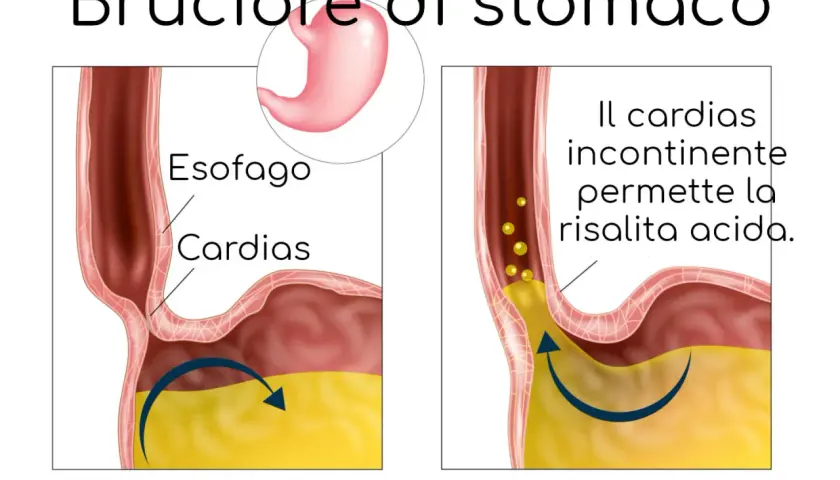Illustrazione del bruciore di stomaco: il cardias incontinente permette la risalita acida, causando fitte allo stomaco.