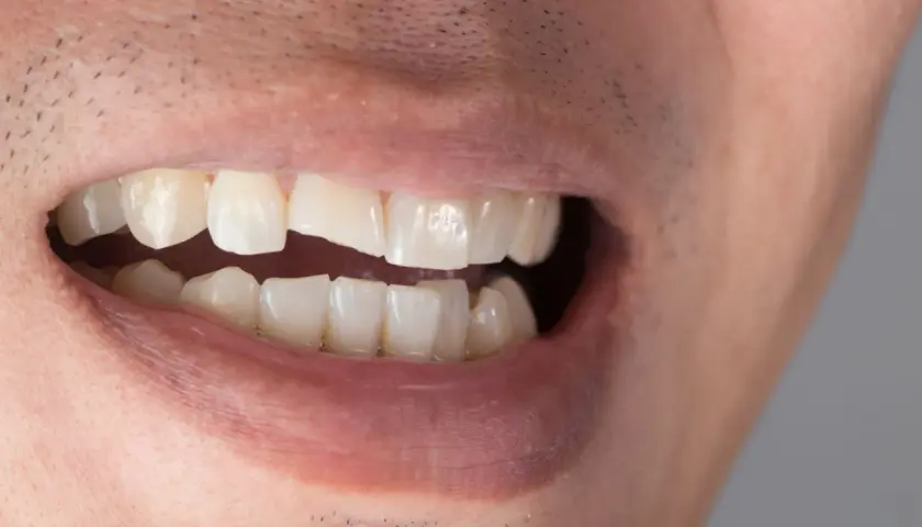 Primo piano di una bocca con un dente scheggiato visibile.
