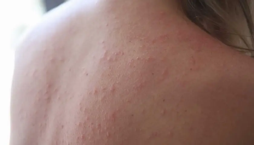 När solen bränner kan huden reagera med små röda prickar och utslag. Här ser du hur soleksem kan se ut på ryggen.
