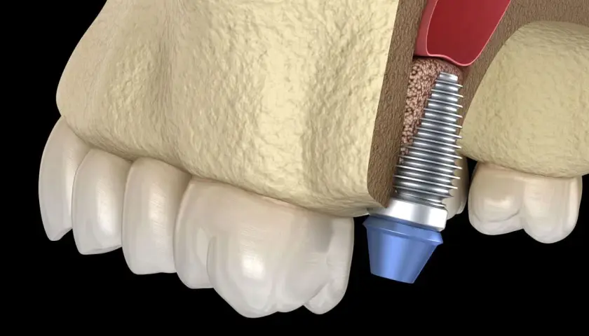 Impianto dentale vicino al seno mascellare. Il rialzo seno mascellare presenta rischi, ma questa immagine mostra la procedura.