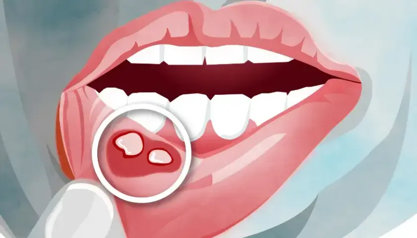 Masz aftę? Czy możesz iść do dentysty? Sprawdź zanim pójdziesz!