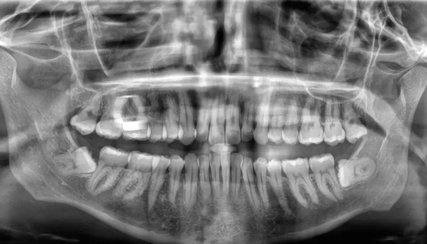 Radiografía panorámica dental. Se observa una muela del juicio impactada, inclinada hacia la mejilla, con posible presión sobre el diente adyacente.