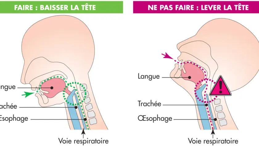 Illustration montrant la bonne (tête baissée) et la mauvaise (tête levée) position pour manger, afin d'éviter la difficulté à avaler et l'obstruction des voies respiratoires.