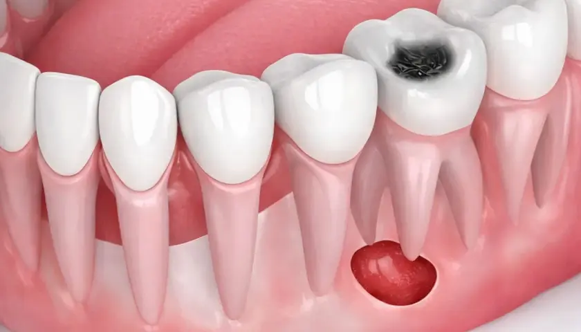 Diente con caries y un quiste odontogénico en la encía.