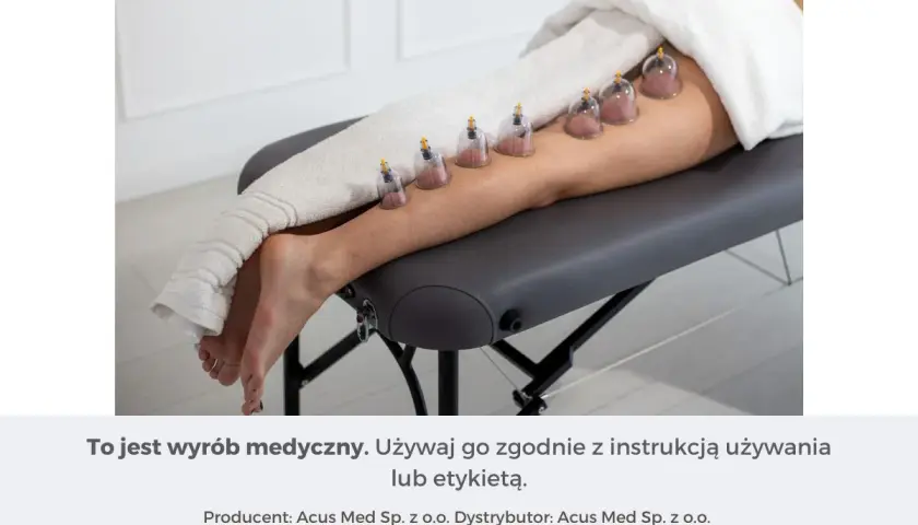 Zabieg stawiania baniek na kolanie. Kilka baniek próżniowych umieszczonych na łydce i udzie.