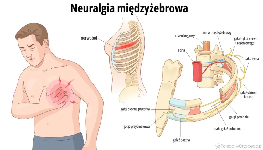Mężczyzna odczuwa ból mostka, ilustracja pokazuje unerwienie żeber i kręgosłupa, wyjaśniając neuralgię międzyżebrową.