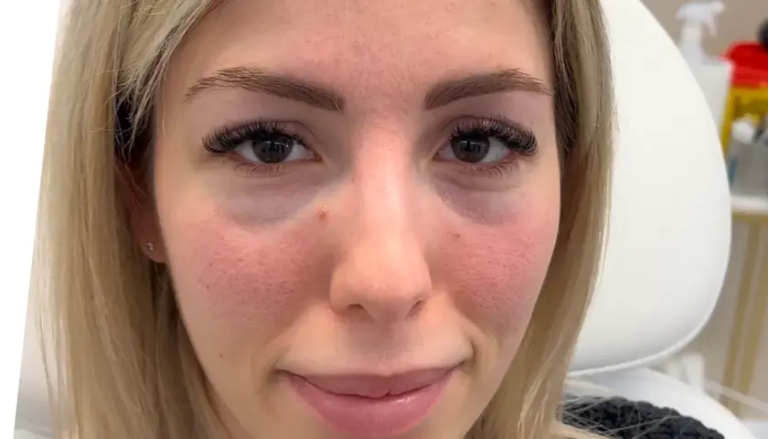 Ansiktsbild av en kvinna med synliga porer och rodnad. Hon har mörka ögonfransar och ljusblont hår. Under ögonen syns en antydan till mörka ringar, vilket kan behandlas med tear trough filler.
