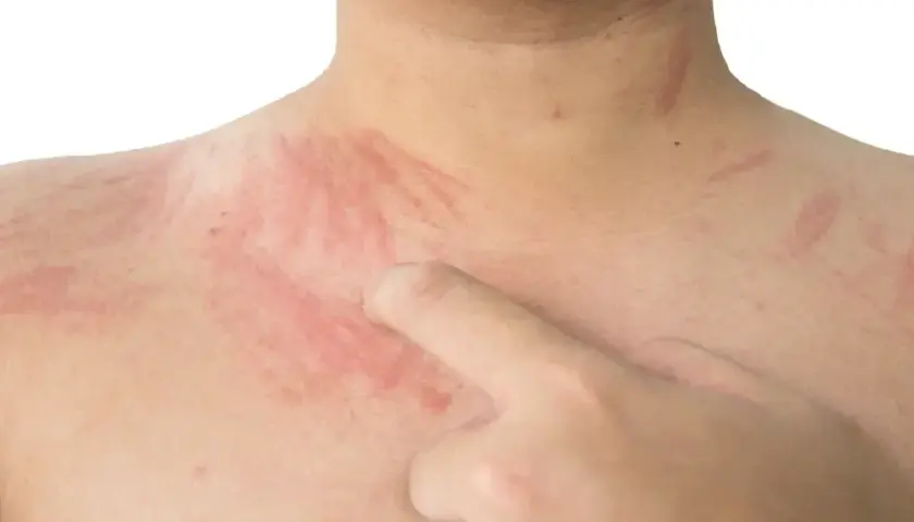 Czerwone pręgi na klatce piersiowej i szyi, widoczna blizna po zadrapaniu paznokciem.