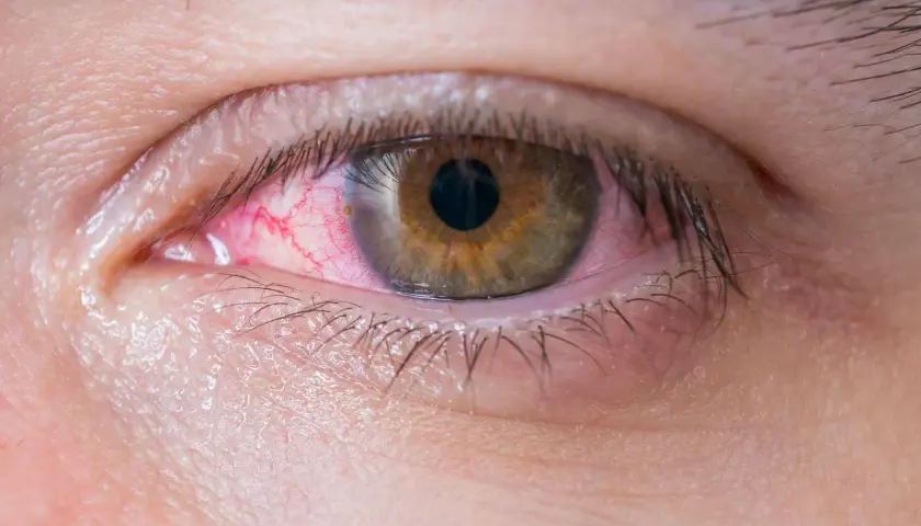Ojo irritado con venas rojas visibles. Parece el ojo de un niño con ojos rojos por alergia o conjuntivitis.