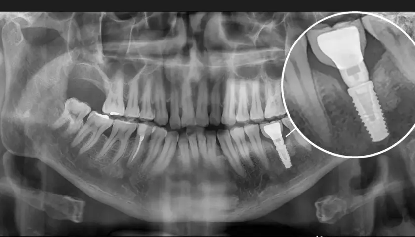 RTG szczęki z widocznym implantem stomatologicznym. Powiększony fragment pokazuje szczegóły augmentacji kości i samego implantu.