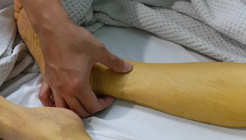 Dłoń bada zażółconą skórę nogi, widoczne objawy żółtaczki.