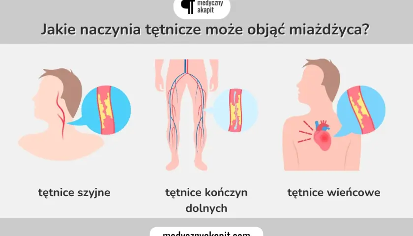 Miażdżyca objawy: zwężone tętnice szyjne, kończyn dolnych i wieńcowe. Ilustracja pokazuje, jak choroba wpływa na naczynia krwionośne.