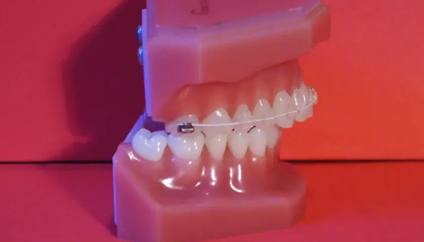 Modelo de dientes con ortodoncia, mostrando cómo los **dientes inclinados hacia afuera** se corrigen.