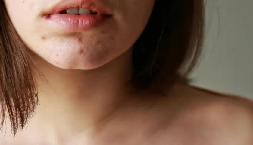 Nahaufnahme von Lippen und Kinn mit Pickeln, die auf Hautveränderungen in den Wechseljahren hindeuten.