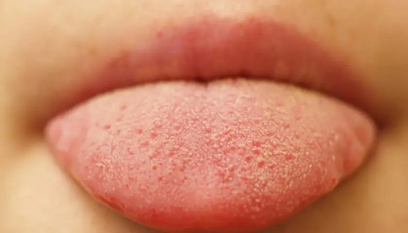 Lingua rossa con piccole bollicine, forse un bambino ha assaggiato qualcosa di nuovo e frizzante!