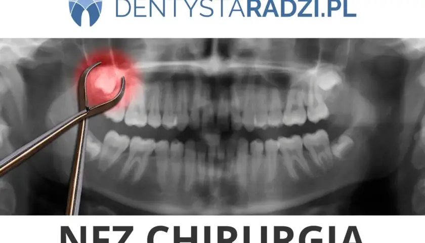 Rentgen zęba z kleszczami i zaznaczonym bólem. Napis NFZ CHIRURGIA.