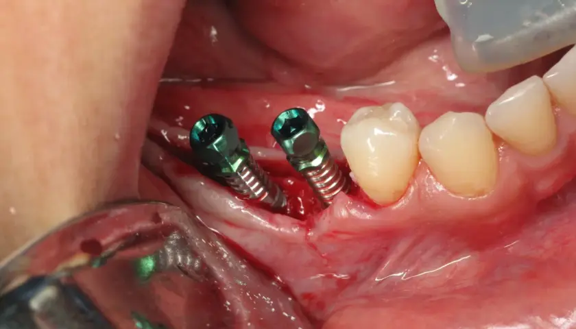 Due viti per impianto dentale sono visibili nella gengiva, pronte per la guarigione. Il dolore post-operatorio è comune, ma gestibile.