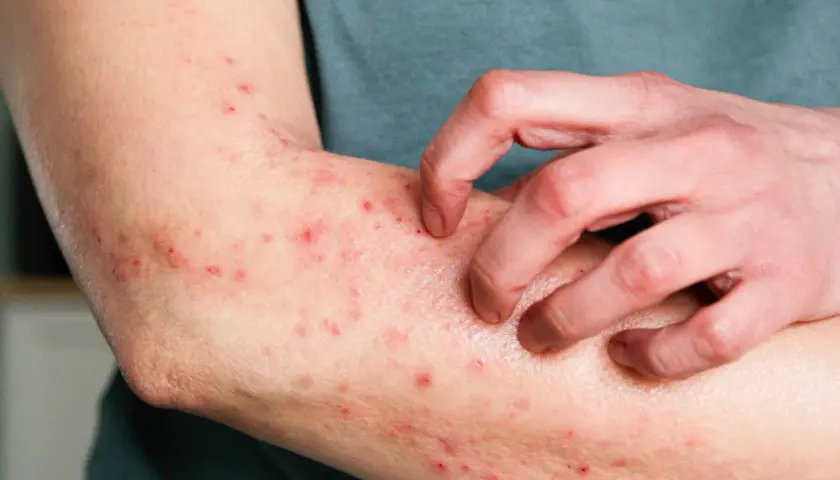 Ramię pokryte czerwonymi krostami alergicznymi, które swędzą i drapią się.