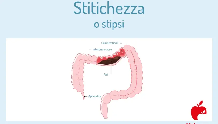 Illustrazione del colon con feci accumulate e gas intestinali, che indica stitichezza. Una purga intestinale potrebbe aiutare.
