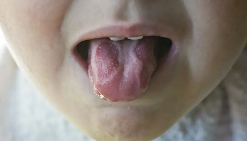Lingua di bambino con piccole vescicole, possibile sintomo di stomatite.