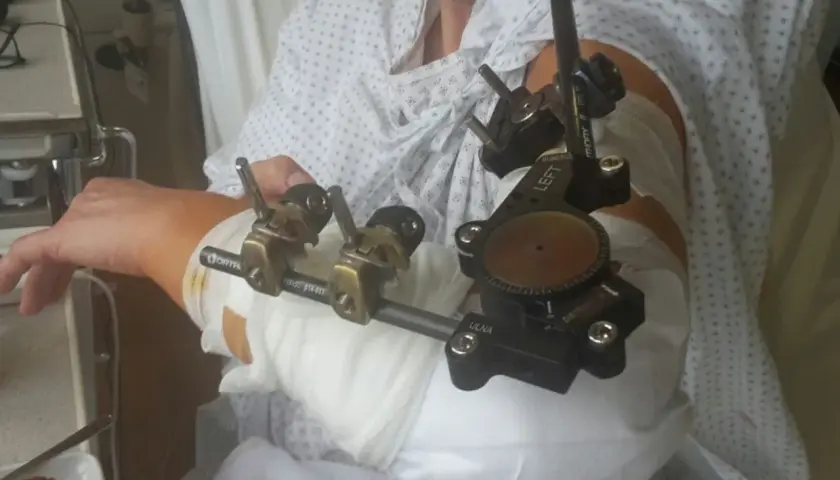 Ein Arm mit einem externen Fixateur, der für die Heilung nach einer Verletzung angelegt wurde. Dieses **halo medizin** Gerät stabilisiert den Knochen.