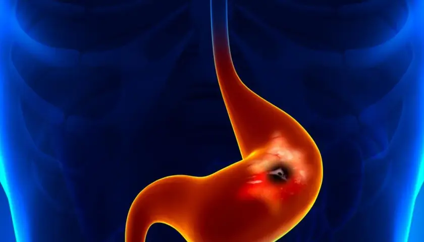 Wrzód żołądka spowodowany przez Helicobacter pylori. Objawy psychiczne mogą towarzyszyć tej chorobie.