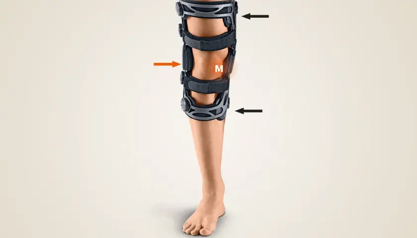 Ein Bein mit einer valgisierenden Orthese, die das Knie stabilisiert. Pfeile zeigen auf die Gelenke der Orthese.