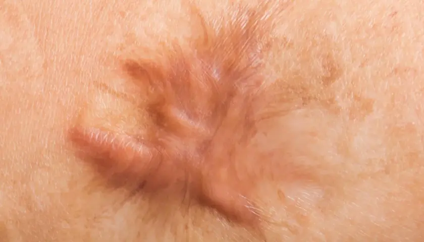 Gros plan d'une cicatrice hypertrophique sur la peau, ressemblant à une cloque sur cicatrice.