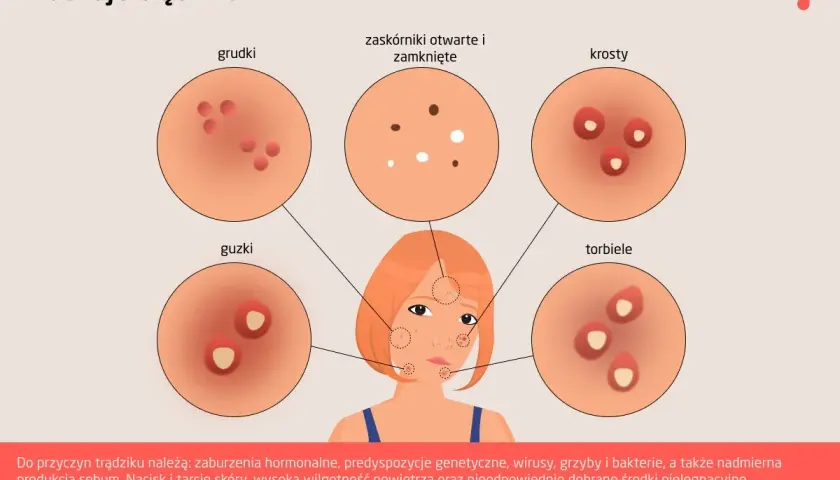 Ilustracja przedstawia różne rodzaje trądziku: grudki, guzki, zaskórniki, krosty i torbiele.