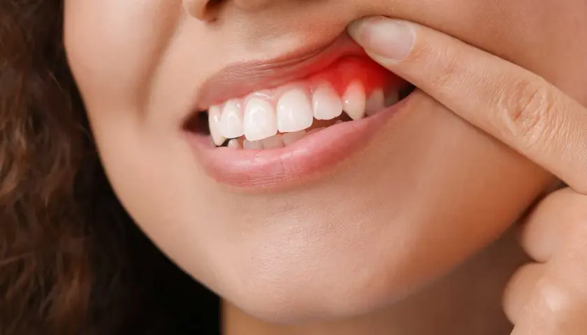Dito che indica una gengiva arrossata e gonfia, sintomo di un possibile ascesso dentale.