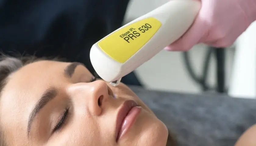 Zabiegi na naczynka na twarzy: laser IPL PRS 530 usuwa widoczne rumieńce i pajączki, przywracając skórze jednolity koloryt.