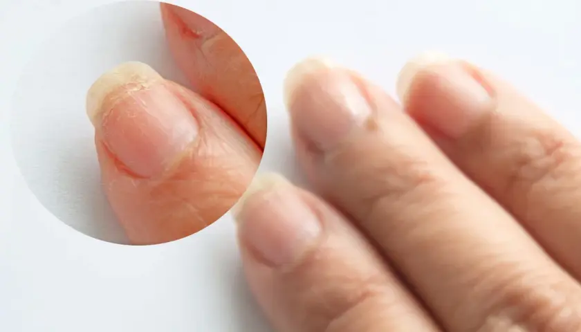 Paznokcie z łuszczącą się płytką, mogą być jednym z objawów wysokiego cholesterolu.