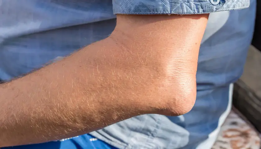 Ein geschwollener Schleimbeutel am Ellenbogen, der unter dem blauen Hemd hervortritt.